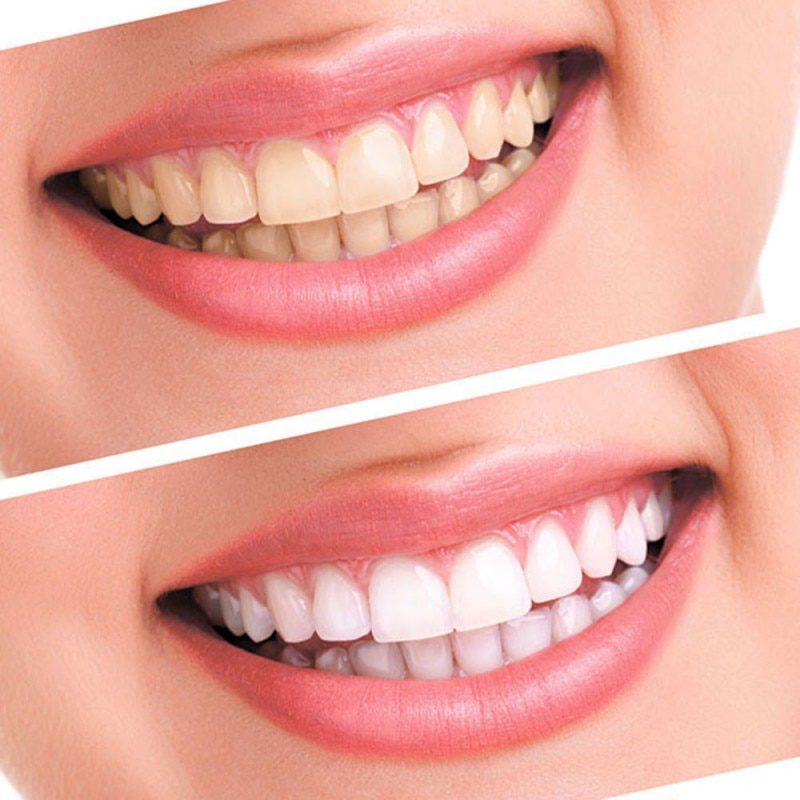 Teeth Whitening 44% Peroxide Dental Bleaching System Oral Gel Kit Tooth Whitener New Dental Equipment 10/6/4/3pcs Beauty Whiten