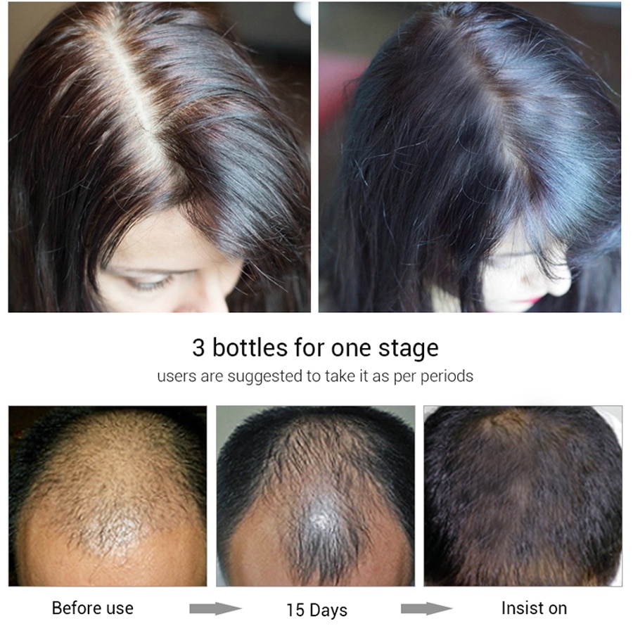 Hair Growth Essence Hair Loss Dense Hair Fast Hair Growth Oil Grow Restoration Growing Serum