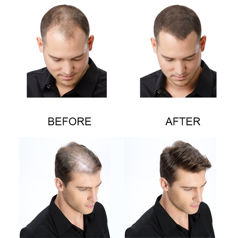 PURC 2019 New Hair Growth Spray Fast Grow Hair hair lossTreatment Preventing Hair Loss 30ml
