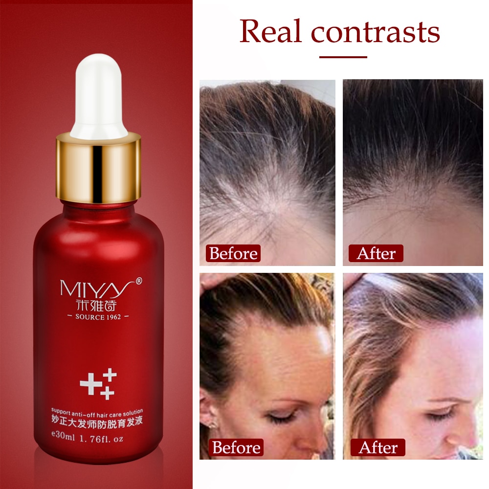 Anti Hair Loss Essence Hair Growth Treatment Oil Fast Thick Hair Eyebrows Support Natural Healthy Hair Treatment for Women