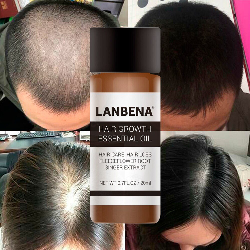 LANBENA Fast Powerful Hair Growth Essence Products Essential Oil Treatment Preventing Hair Loss Hair Care Andrea 20ml !