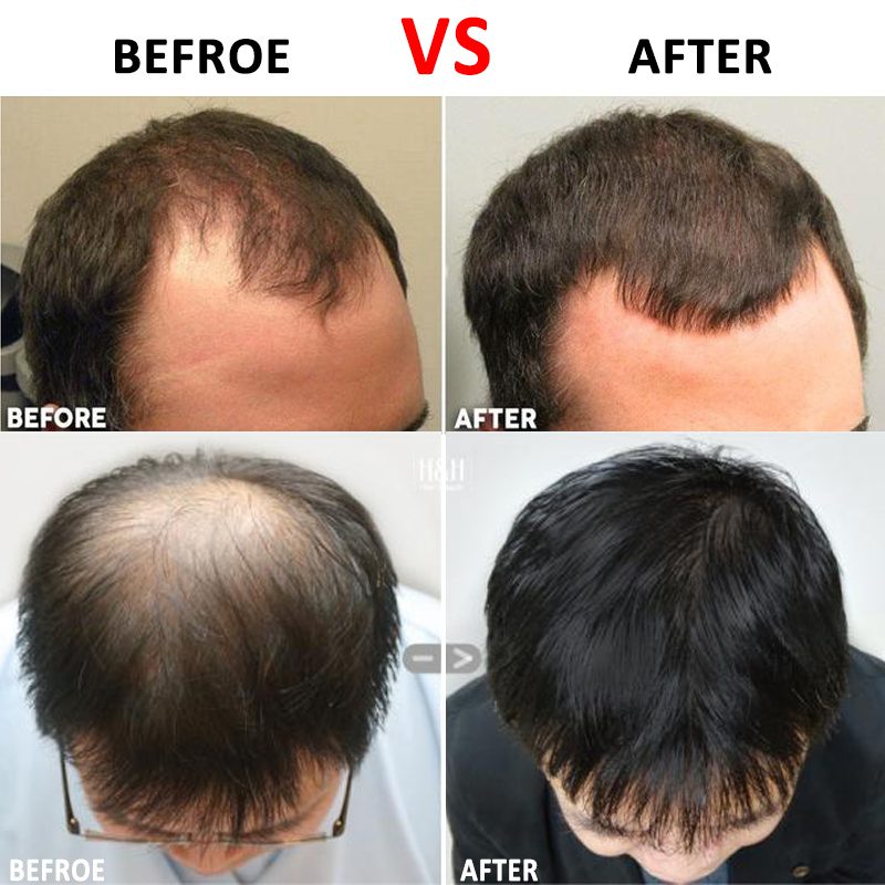 Titanium Micro Needle Roller for Face and Hair Regrowth Anti Hair Loss Treatment Thinning Hair/ Bald Spots / Receding Hairline Titanium Micro Needle Roller for Face and Hair Regrowth Anti Hair Loss Treatment Thinning Hair/ Bald Spots / Receding Hairline