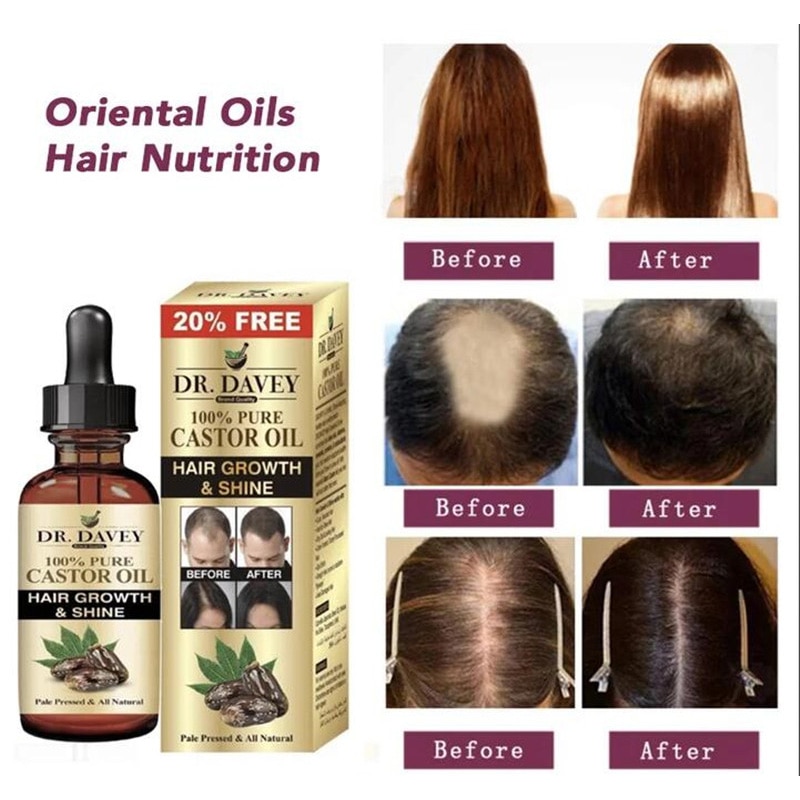 Oriental Oils Hair Nutrition Hair Loss Treatment Solutions Product Fast Hair Growth Remedy Essence Oil Hair Regrowth Products