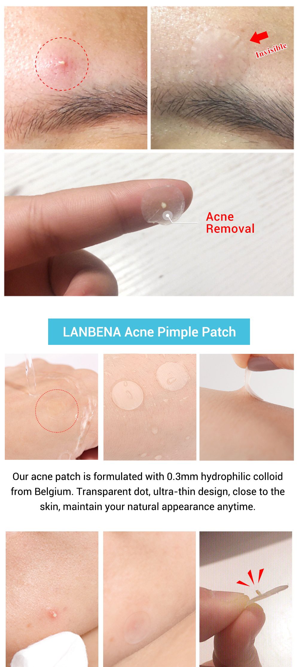 LANBENA Acne Removal Patch Acne Treatment Mask Anti Acne Stickers Blackhead Pimple Remover Face Cream Facial Tool Skin Care