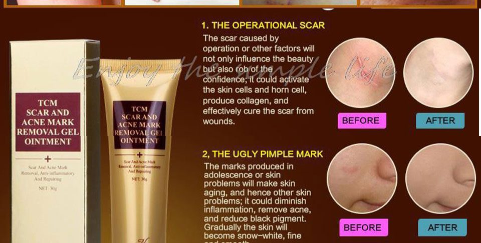 LANBENA Acne Scar Removal Strentch Marks Acne Treatment Shrink Pores Gel Bleaching Essence Whitening  Face Cream Skin Care