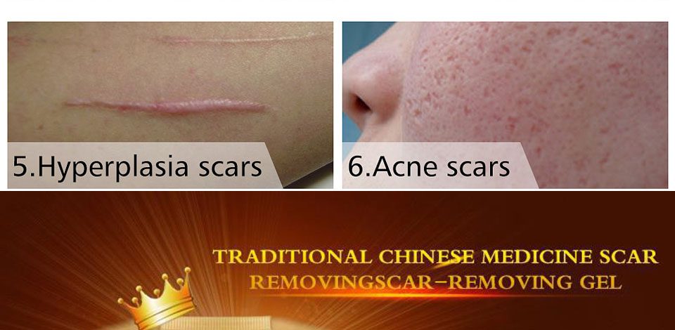 LANBENA Acne Scar Removal Strentch Marks Acne Treatment Shrink Pores Gel Bleaching Essence Whitening  Face Cream Skin Care