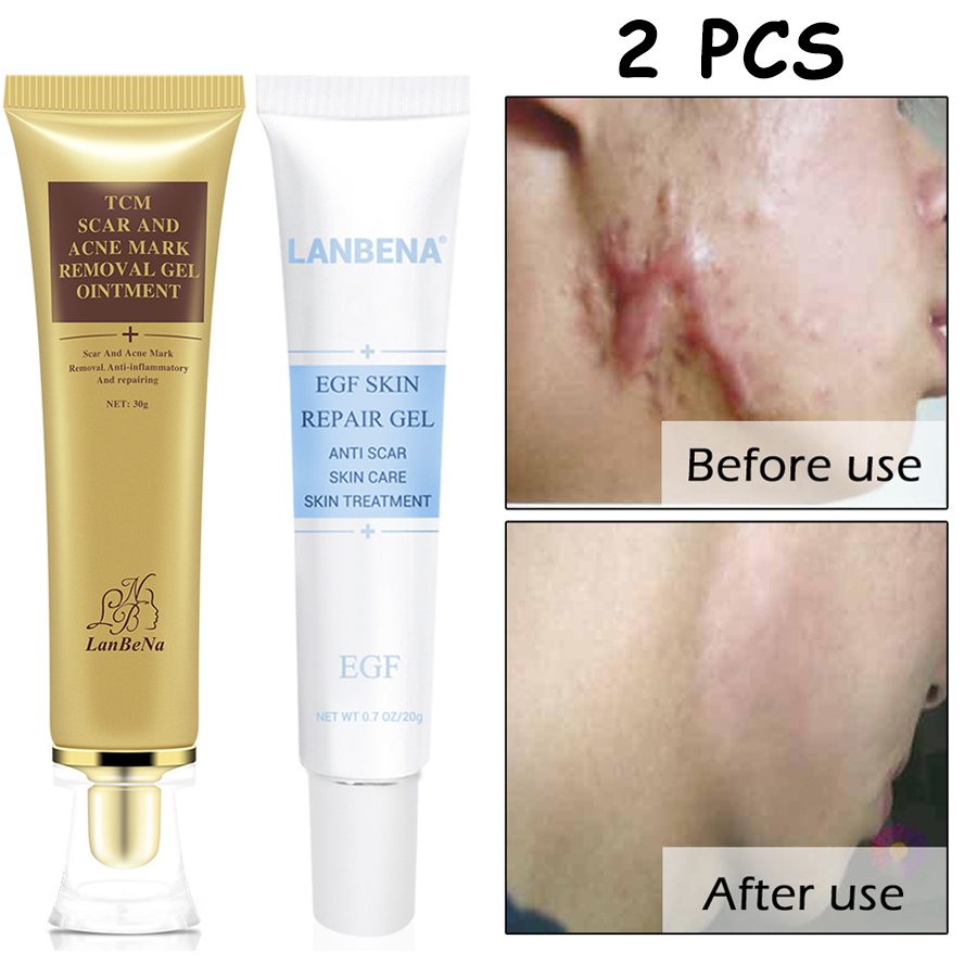 LANBENA Acne Scar Removal Strentch Marks Acne Treatment Shrink Pores Gel Bleaching Essence Whitening  Face Cream Skin Care