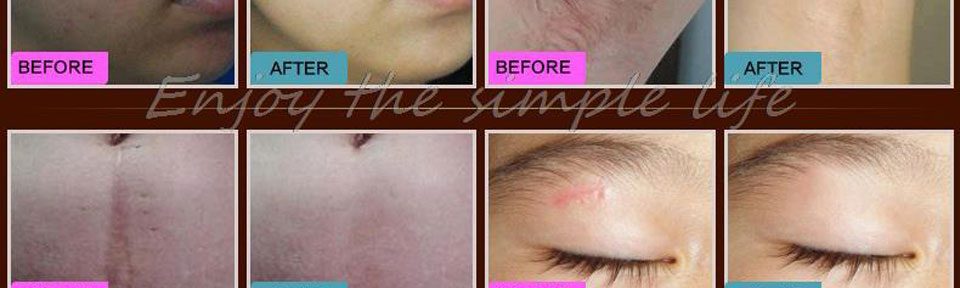 LANBENA Acne Scar Removal Strentch Marks Acne Treatment Shrink Pores Gel Bleaching Essence Whitening  Face Cream Skin Care