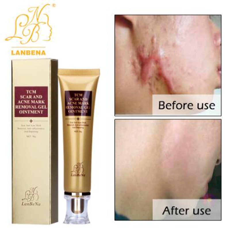 LANBENA Acne Scar Removal Strentch Marks Acne Treatment Shrink Pores Gel Bleaching Essence Whitening  Face Cream Skin Care