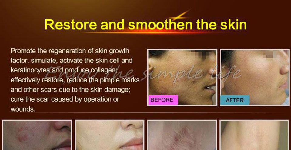 LANBENA Acne Scar Removal Strentch Marks Acne Treatment Shrink Pores Gel Bleaching Essence Whitening  Face Cream Skin Care