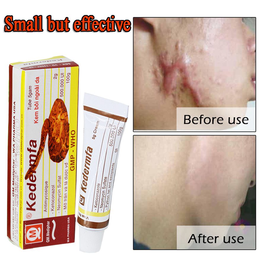 LANBENA Acne Scar Removal Strentch Marks Acne Treatment Shrink Pores Gel Bleaching Essence Whitening  Face Cream Skin Care