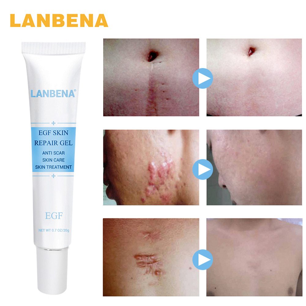 LANBENA Acne Scar Removal Strentch Marks Acne Treatment Shrink Pores Gel Bleaching Essence Whitening  Face Cream Skin Care