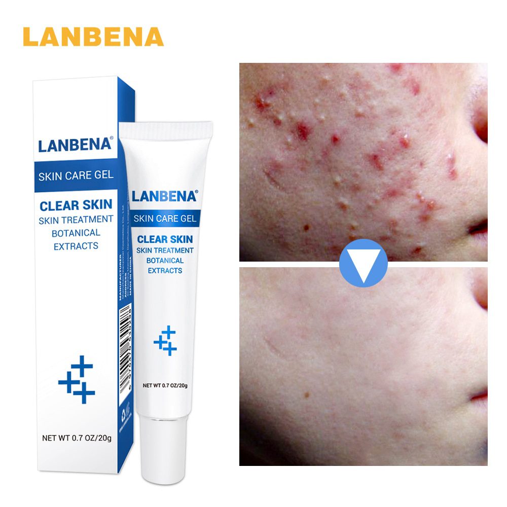 LANBENA Acne Scar Removal Strentch Marks Acne Treatment Shrink Pores Gel Bleaching Essence Whitening  Face Cream Skin Care