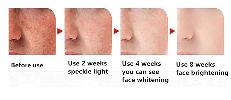 Dimollaure Strong effect whitening cream +Kojic acid serum Remove Freckle melasma pigment Melanin sunburn Acne scars brown Spot