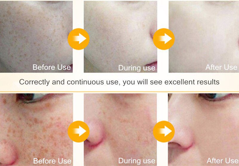 Dimollaure 30g pure Kojic Acid whitening cream+Kojic Acid serum Wrinkle removal Freckle melasma Acne scar pigmentt melanin cream