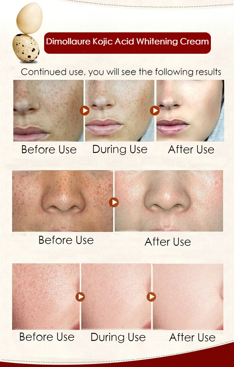 Dimollaure Kojic Acid whitening cream 30g Retinol Wrinkle removal Freckle melasma Acne scar pigment age spot melanin sun spot