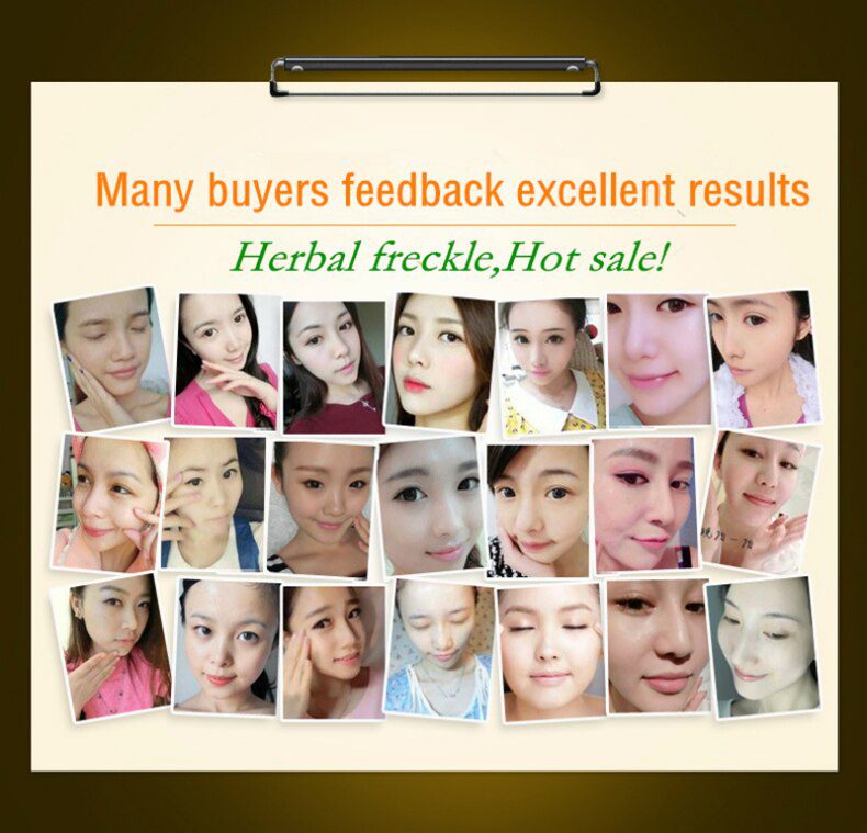 Dimollaure Kojic Acid whitening cream 30g Retinol Wrinkle removal Freckle melasma Acne scar pigment age spot melanin sun spot