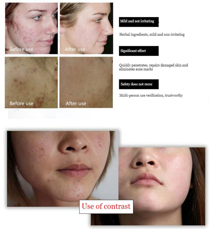 Dimollaure 20g Acne Treatment Blackhead Removal Anti Acne Cream Oil Control Repair Comedone Pimple Acne Scar Remove Skin Care