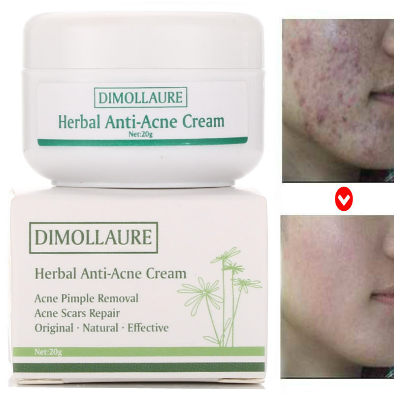 Dimollaure 20g Acne Treatment Blackhead Removal Anti Acne Cream Oil Control Repair Comedone Pimple Acne Scar Remove Skin Care