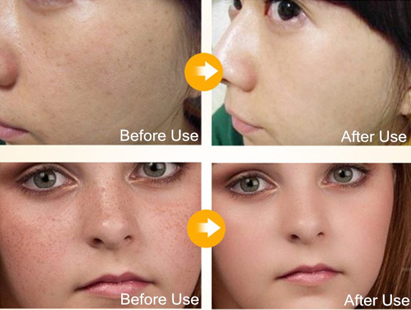 Dimollaure Kojic acid Whitening Cream Retinol Vitamin A serum Remove Freckle melasma pigment Melanin Acne scar dark Spots