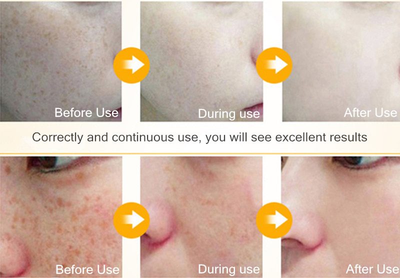 Dimollaure Kojic acid Whitening Cream Retinol Vitamin A serum Remove Freckle melasma pigment Melanin Acne scar dark Spots