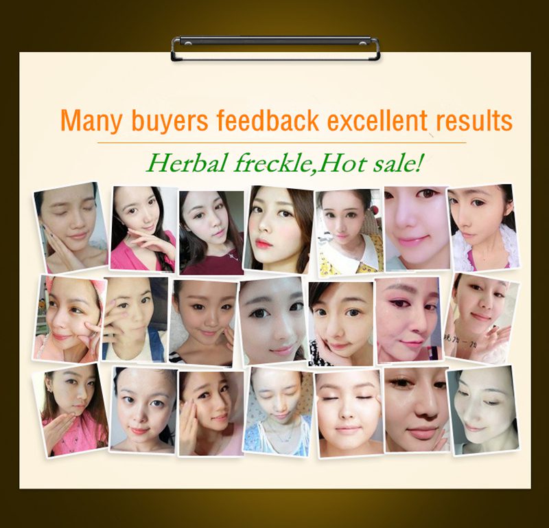 Dimollaure Retinol whitening cream +Kojic acid serum Remove Freckle melasma pigment Melanin sunburn Acne scars brown Spot Dimollaure Retinol whitening cream +Kojic acid serum Remove Freckle melasma pigment Melanin sunburn Acne scars brown Spot