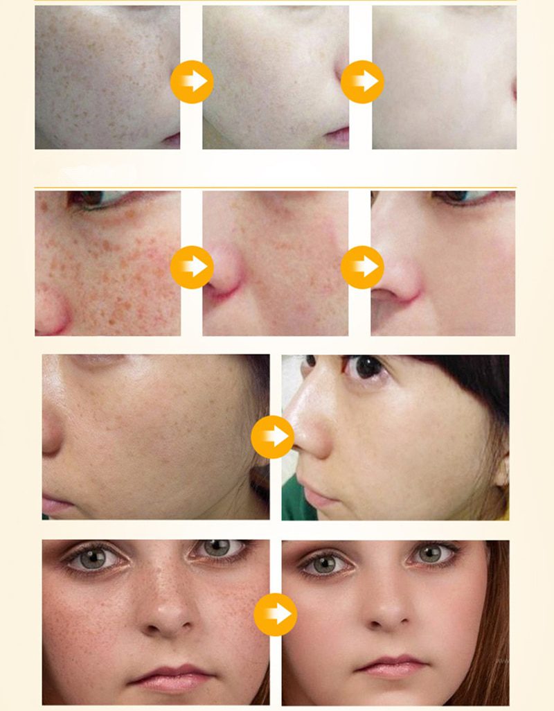 Dimollaure kojic acid Retinol whitening cream Vitamin C peptides Argireline serum Remov Freckle melasma pigment Melanin darkSpot