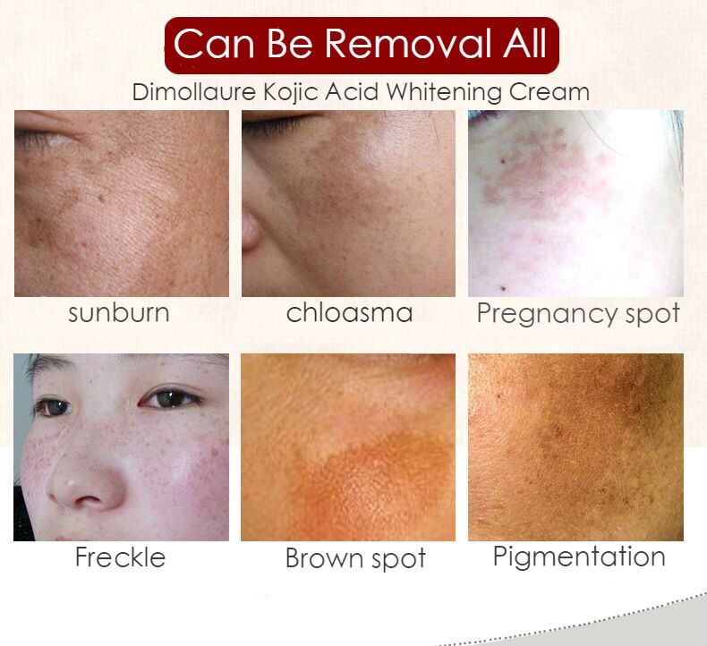 3pcs Dimollaure Kojic Acid Tender whitening Freckle cream Wrinkle removal melasma Acne scar pigment melanin sun spot face care
