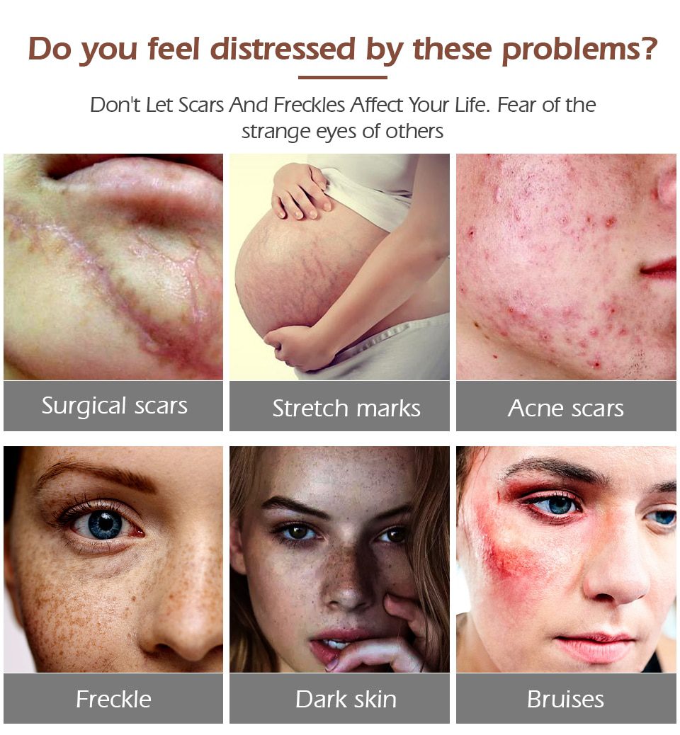 VIBRANT GLAMOUR Repair Scar Removal Cream Acne Scars Gel Stretch Marks Surgical Scar Burn For Body Pigmentation Corrector Care VIBRANT GLAMOUR Repair Scar Removal Cream Acne Scars Gel Stretch Marks Surgical Scar Burn For Body Pigmentation Corrector Care