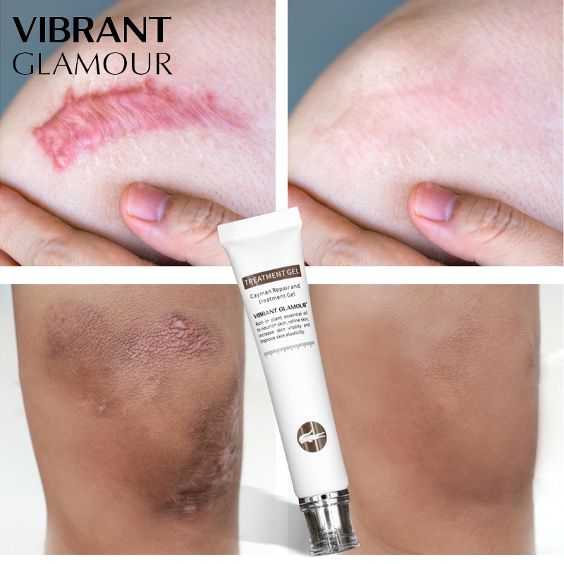 VIBRANT GLAMOUR Repair Scar Removal Cream Acne Scars Gel Stretch Marks Surgical Scar Burn For Body Pigmentation Corrector Care