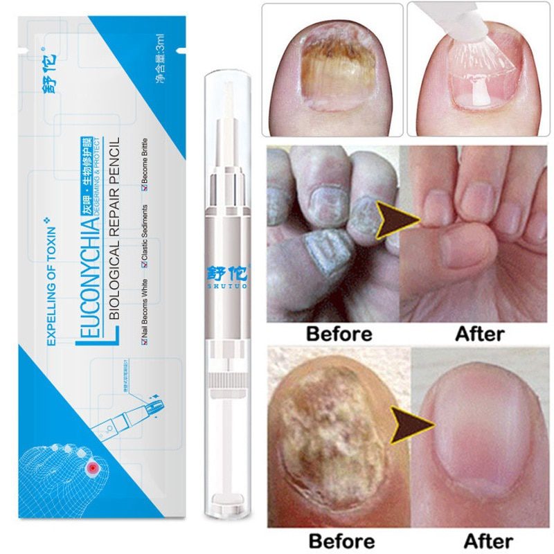 3ML Nail Fungus Treatment Nail Oil Pen Anti Fungal Nail Cuticle Remover Liquid Nail Growth Skin Care TSLM2