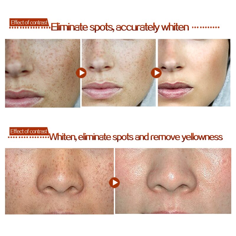 MEIKING Dark Spot Corrector Skin Whitening Fade Cream Lightening Blemish Removal Serum Reduces Age Spots Freckles Melasma Cream