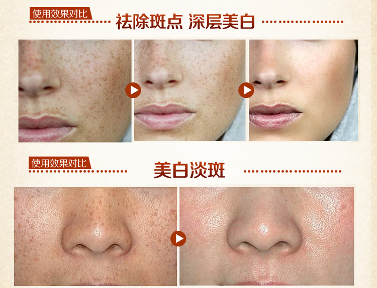MEIKING Dark Spot Corrector Skin Whitening Fade Cream Lightening Blemish Removal Serum Reduces Age Spots Freckles Melasma cream