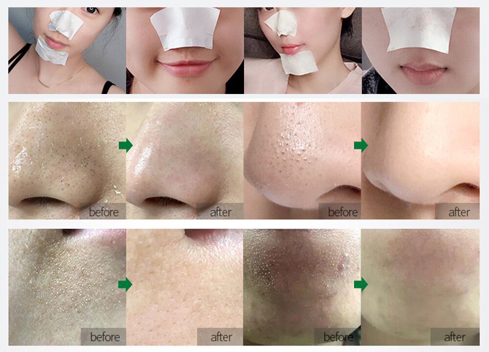 BREYLEE Tea Tree Blackhead Remover Serum Shrink Pores Essence Black Peeling Mask Oil-Control Face Sheet Mask Whitening Skin Care