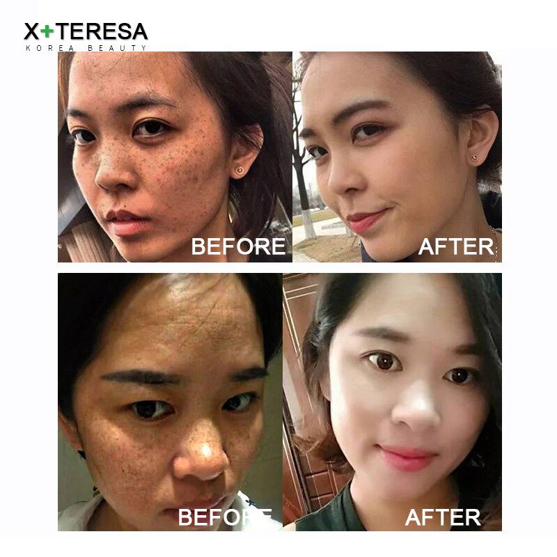 Dark Spot Corrector Whitening Serum Face Bleaching Serum Brighten Blemish Freckle Remover Natural Carrot Essence Korea Skin Care