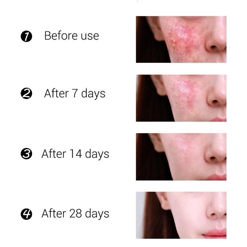 2022 Best Organic Whitening Herbal Tea Tree Oil Acne Spot Treatment Removing Anti Acne Face Cream