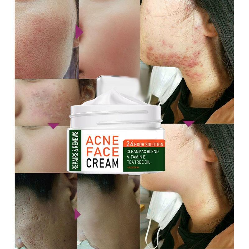 2022 Best Organic Whitening Herbal Tea Tree Oil Acne Spot Treatment Removing Anti Acne Face Cream