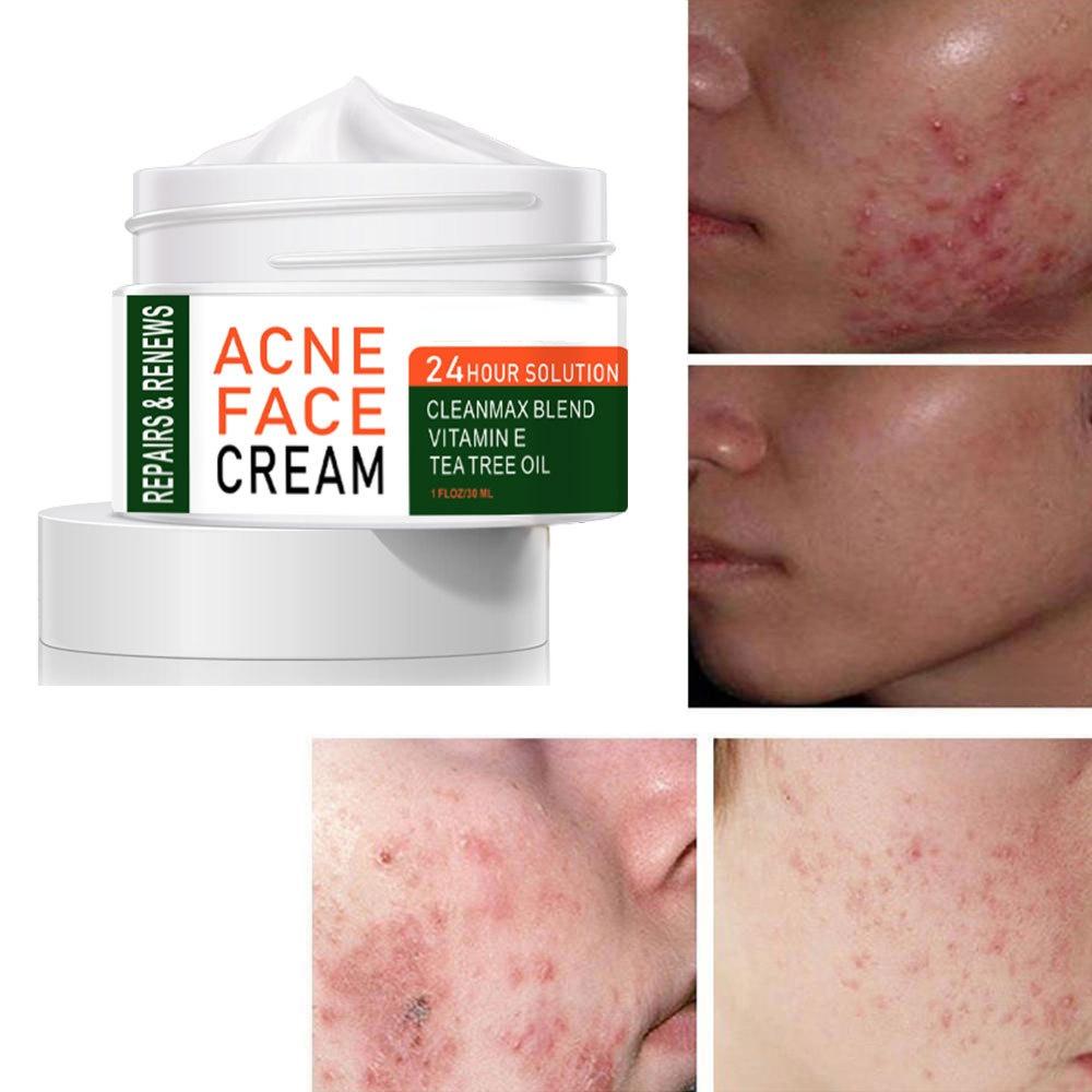 2022 Best Organic Whitening Herbal Tea Tree Oil Acne Spot Treatment Removing Anti Acne Face Cream
