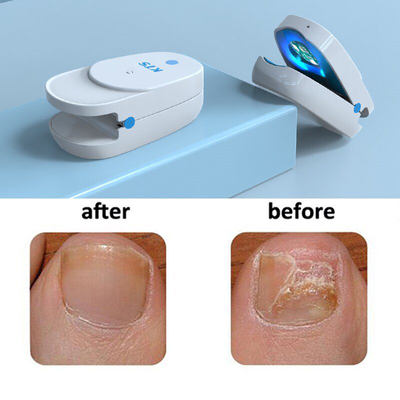 Fungal Nail Treatment Laser Device For Nail Fungus 905nm 470nm Fungus Nail Removal Anti Infection Paronychia Onychomycosis Care