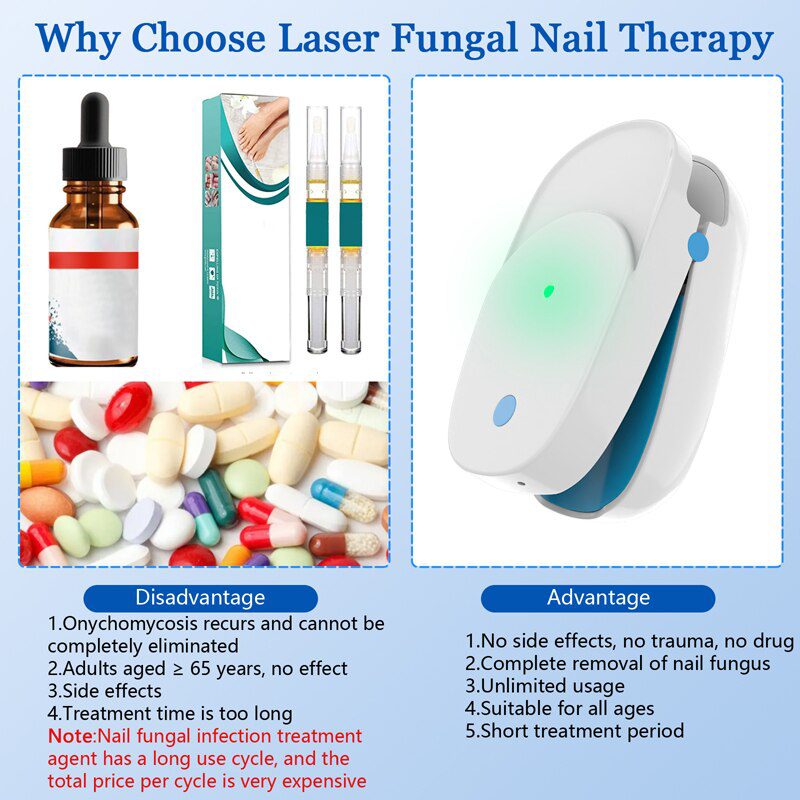 Fungal Nail Treatment Laser Device For Nail Fungus 905nm 470nm Fungus Nail Removal Anti Infection Paronychia Onychomycosis Care